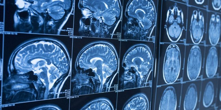 Diferencias entre Parkinson y temblor esencial: cómo identificar cada uno y cuándo acudir al médico