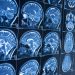 Diferencias entre Parkinson y temblor esencial: cómo identificar cada uno y cuándo acudir al médico