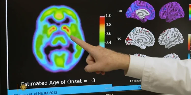 Un análisis de sangre para la enfermedad de Alzheimer puede predecir quién tiene probabilidades de desarrollar síntomas en 5 a 10 años