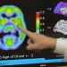 Un análisis de sangre para la enfermedad de Alzheimer puede predecir quién tiene probabilidades de desarrollar síntomas en 5 a 10 años Un análisis de sangre para la enfermedad de Alzheimer puede predecir quién tiene probabilidades de desarrollar síntomas en 5 a 10 años
