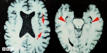 NFL: At least one in four dead players had brain disease, says study NFL: At least one in four dead players had brain disease, says study