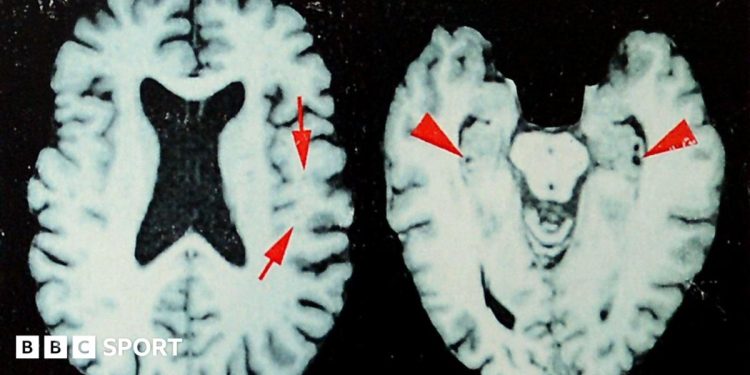 NFL: At least one in four dead players had brain disease, says study